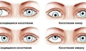 Проявления и лечение скрытого косоглазия у детей и взрослых
