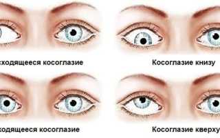 Проявления и лечение скрытого косоглазия у детей и взрослых