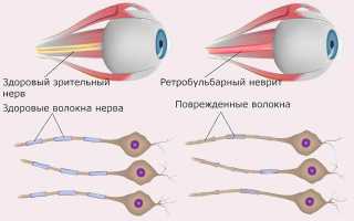 Причины возникновения и методы лечения ретробульбарного неврита у пациентов