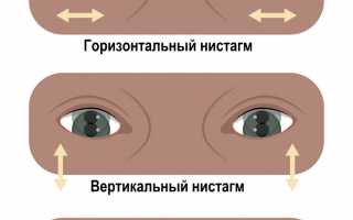 Что такое нистагм глаза и его причины