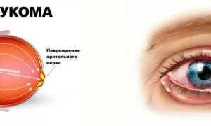Возможно ли полностью вылечить глаукому и сохранить зрение?
