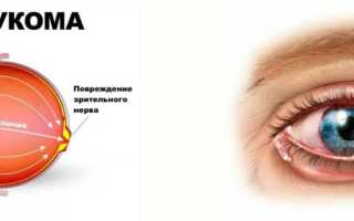 Возможно ли полностью вылечить глаукому и сохранить зрение?