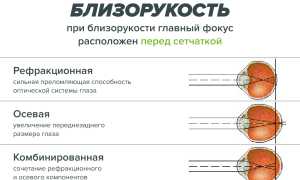Причины развития и методы коррекции близорукости и дальнозоркости у детей и взрослых