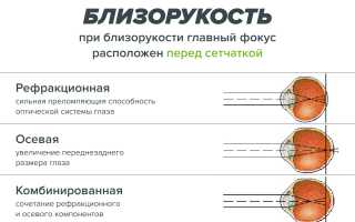 Причины развития и методы коррекции близорукости и дальнозоркости у детей и взрослых