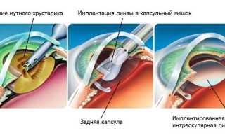 Операция катаракты при глаукоме: важные аспекты и рекомендации
