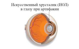 Когда применяется артифакия глаза, возможные осложнения и рекомендации