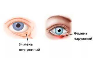 Особенности лечения ячменя на глазу у ребёнка: советы и рекомендации